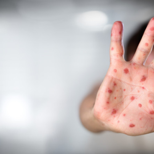 Moartea unui copil bolnav de rujeolă a stârnit un val de conspirații antivacciniste în Marea Britanie